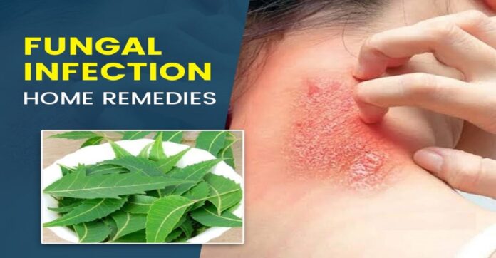 Home Remedies for Common Fungal Infections