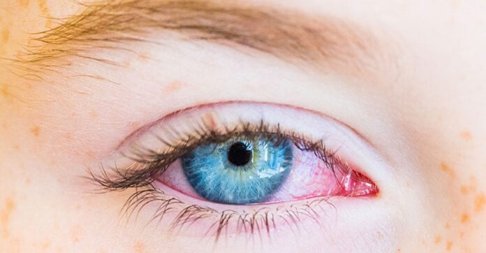 Home Remedies for Pink Eye